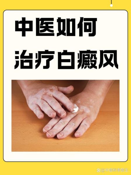 白癜风非物质文化遗产（白癜风非遗疗法靠谱吗）-第1张图片-八三百科