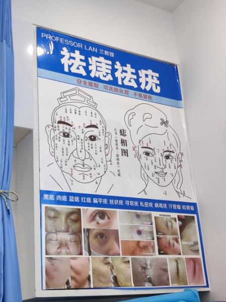 非物质文化遗产痣(非遗点痣技艺是什么)-第1张图片-八三百科 非物质文化遗产痣(非遗点痣技艺是什么)-第1张图片-八三百科