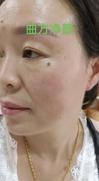 非物质文化遗产痣(非遗点痣技艺是什么)-第2张图片-八三百科 非物质文化遗产痣(非遗点痣技艺是什么)-第2张图片-八三百科