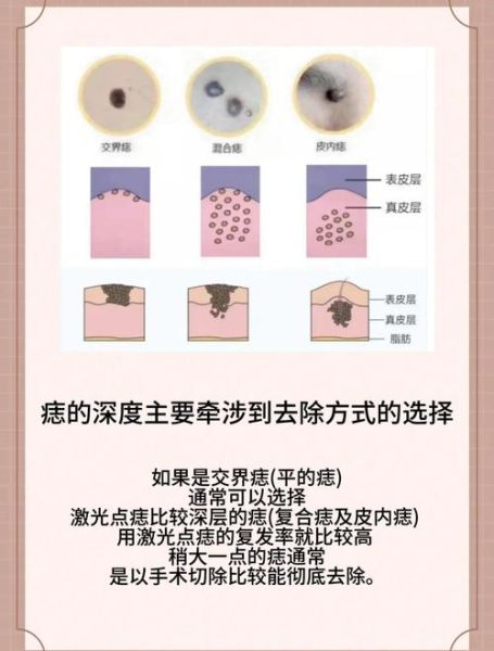 非物质文化遗产点痣（非物质文化遗产点痣合法吗）-第3张图片-八三百科